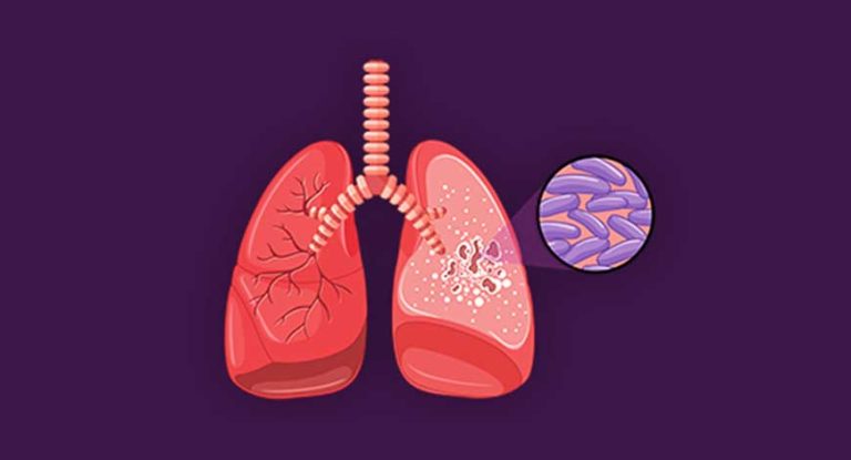 ICMR issues standard treatment workflows for TB management - Medical Buyer