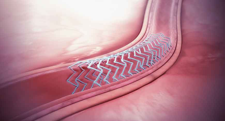 Stents